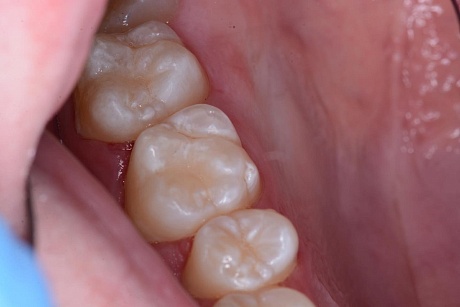 Пример удаления кариеса дентина жевательной поверхности зубов