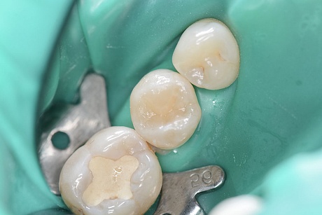 Пример лечения кариеса дентина жевательной поверхности зубов у пациента