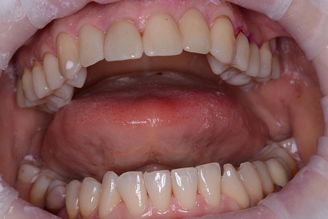 Профессиональная гигиена полости рта у пациента