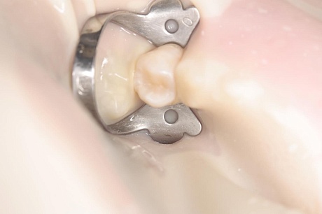 Лечение кариеса дентина жевательной поверхности зубов