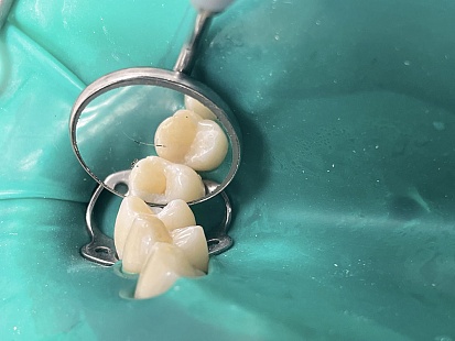 Пример устранения кариеса дентина жевательной поверхности зубов