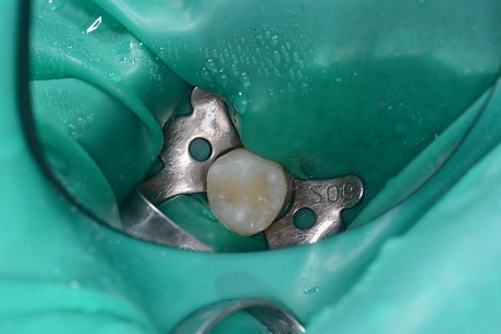 Лечение кариеса дентина жевательной поверхности зубов у пациента