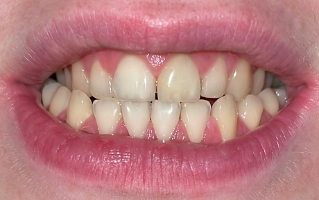 Пример успешного лечения диклорита зубов у пациента